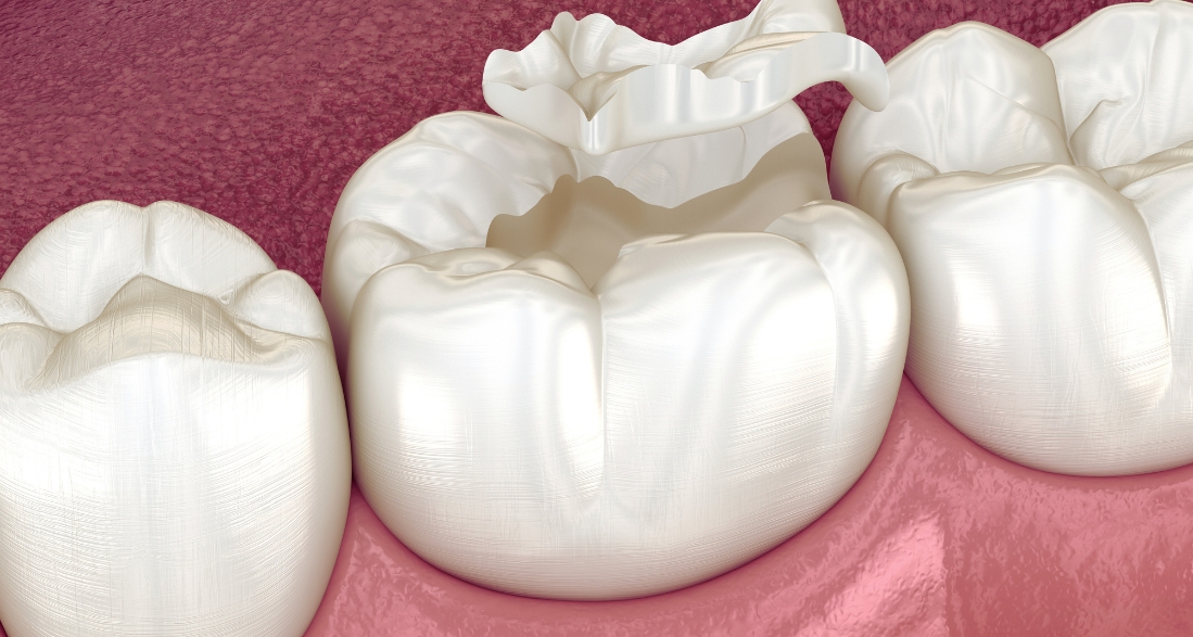 dental sealants for kids the best cavity defense