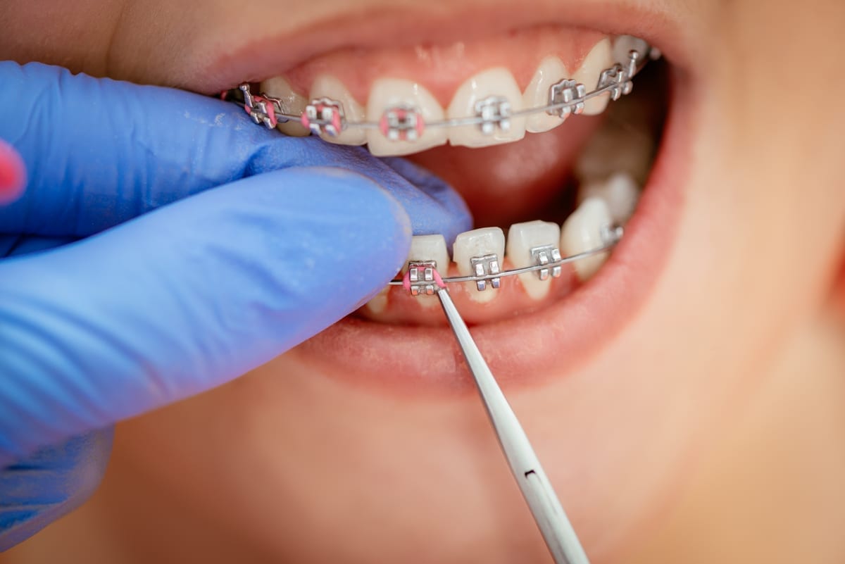 Dental Bridges in Allen Park